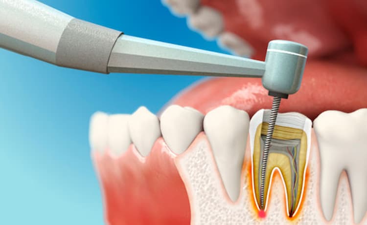 هزینه انجام کار توسط متخصص ریشه دندان چقدر است؟