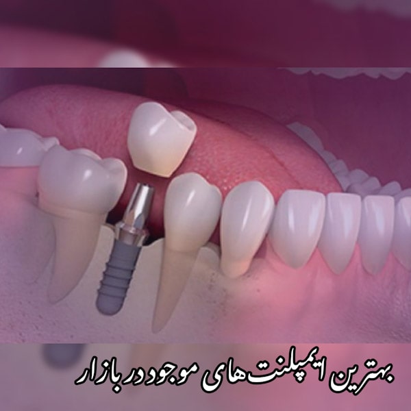 قیمت ایمپلنت دندان در کرج
