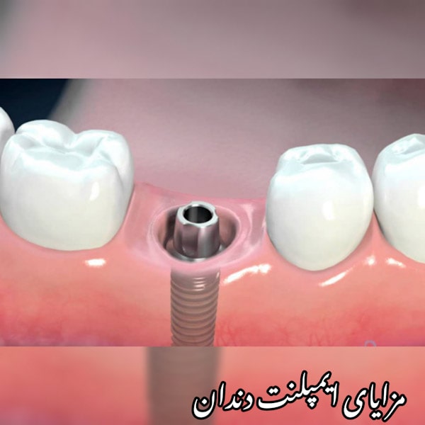 هزینه ایمپلنت دندان در کرج