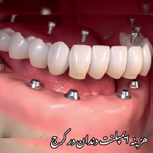 هزینه ایمپلنت دندان قیمت مناسب و ارزان در کرج