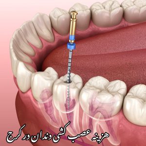 هزینه عصب کشی دندان در کرج
